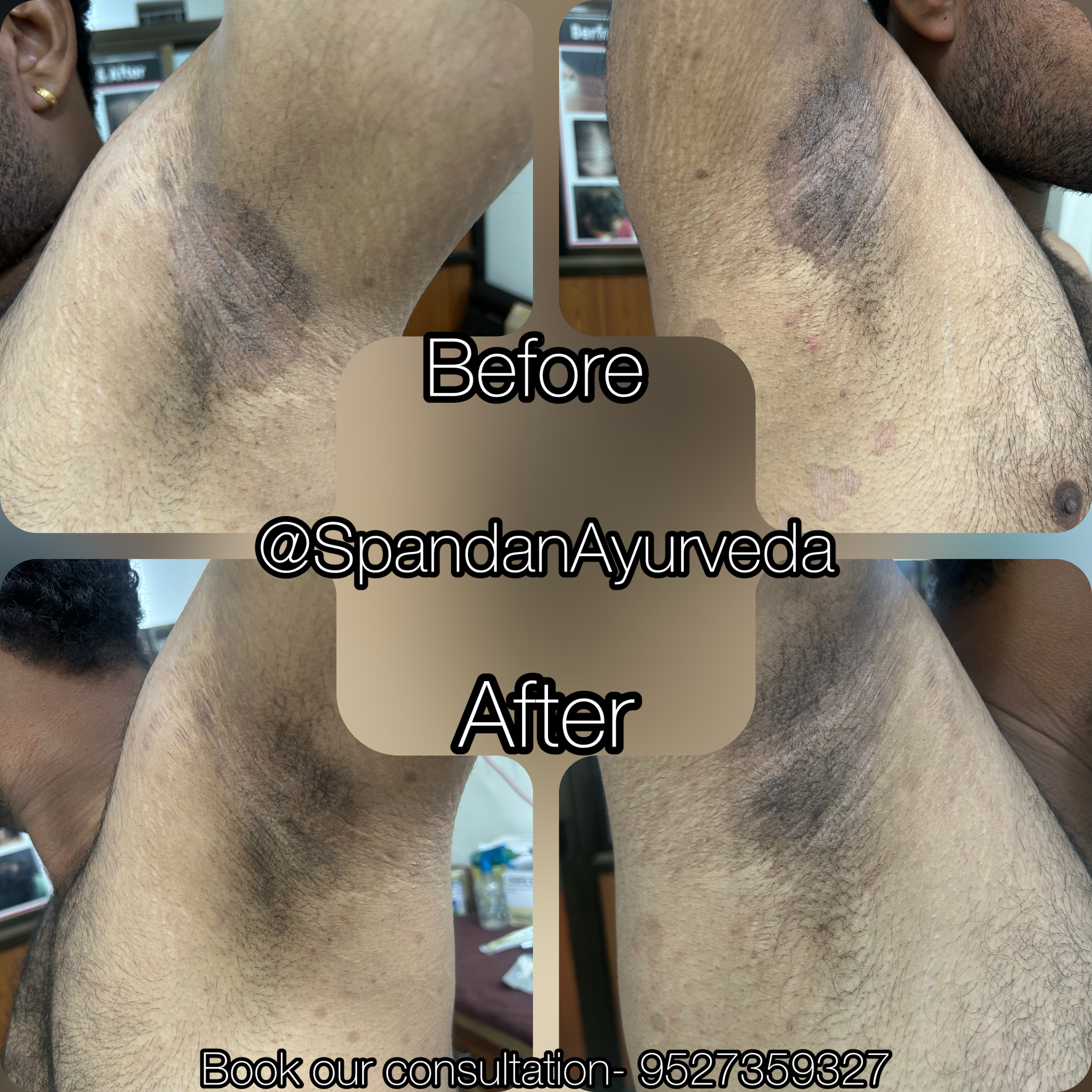 Ringworm infection cured completely in 15 days, steroid-free treatment by following complete Ayurveda principles relieved severe underarm itching and got cured .